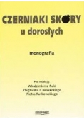 Czerniak skóry u dorosłych