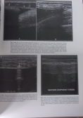 Ultrasonografia piersi