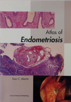 Atlas of Endometriosis