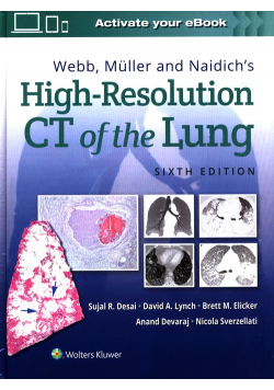 Webb, Müller and Naidich's High-Resolution CT of the Lung Sixth edition